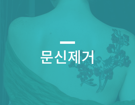 문신제거